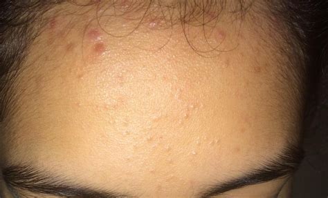 Hairline Acne What Is It And How Do You Get Rid Of It Skincareaddicts