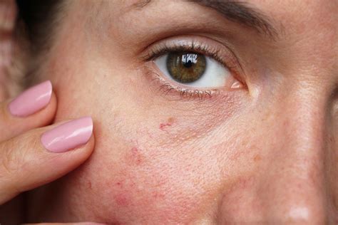Skin Redness Heres What Might Be Causing It Glow Recipe