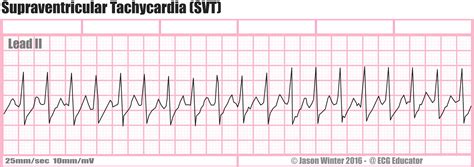 Episodes may only last for a few minutes or may last for up to several months. Psvt Ecg / Supraventricular Tachycardia Wikivisually ...