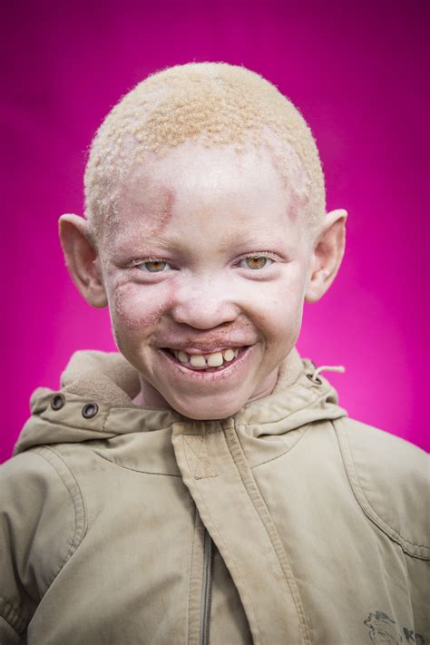 A Young Albino Boy Laughs As He Has His Portrait Taken At An Orphanage