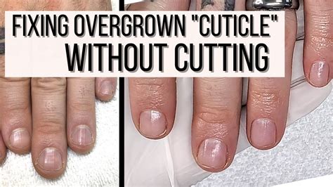 Top 172 How To Treat Very Dry Cuticles And Skin Around Nails