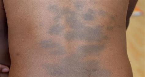 Mongolian Birthmark Or Spot Causes Signs And Removal Skincarederm