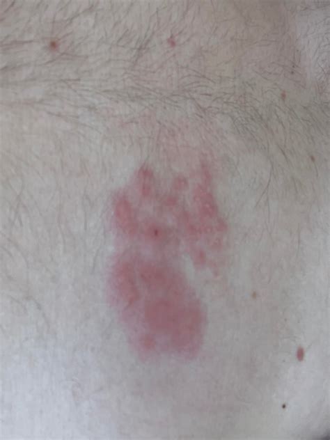 Shingles Bug Bite Cant See A Dermatologist Until Thursday Any