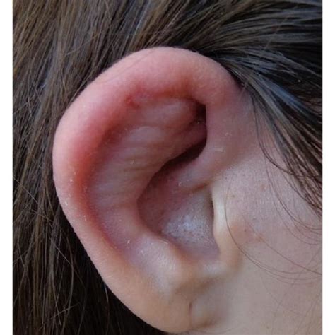 A B Cauliflower Ears Swelling And Erythema Of The Cartilaginous