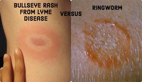 Bullseye Rashes Ringworm And Lyme Disease Differences And My Diagnosis