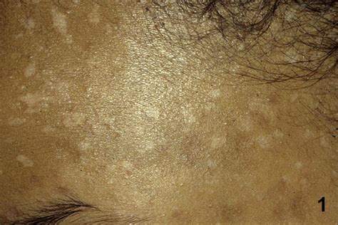 Hypopigmented Macules Journal Of The American Academy Of Dermatology