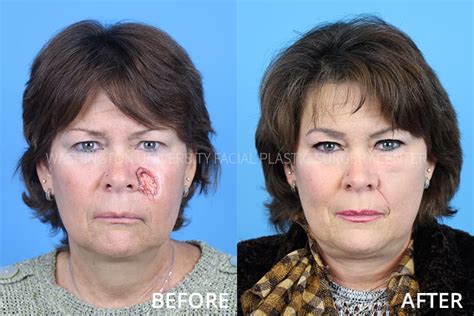 Cheek Reconstruction Facial Plastic Surgery Center Washington