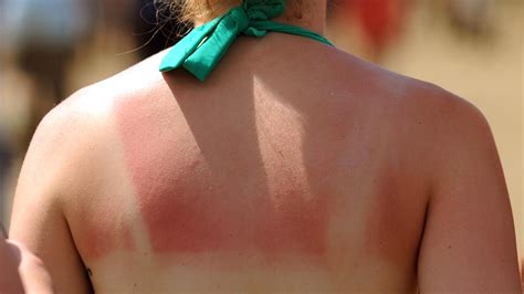 How To Soothe Your Sunburn This Morning