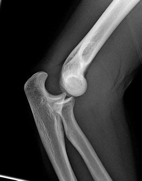 Elbow Dislocation Teachmesurgery