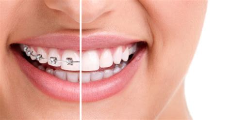 Important Things To Know Before You Get Dental Braces Dreamworks Dental Irving