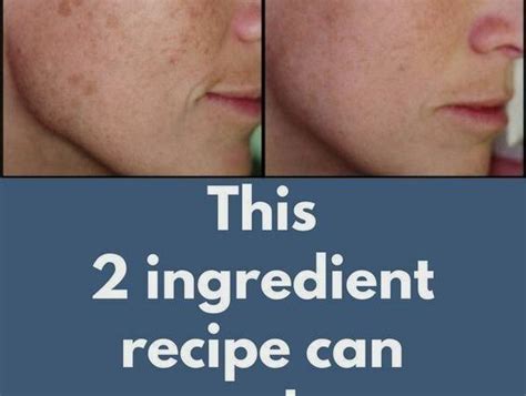 Brown Spots What Are The Most Effective Active Ingredients To Get Rid