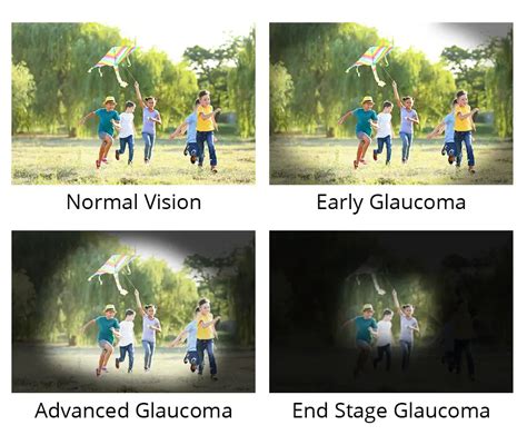 Glaucoma Testing And Treatment In Faribault Richie Eye Clinic