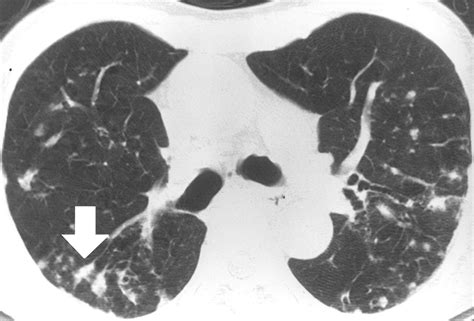 Radiographic And Ct Findings Of Nontuberculous Mycobacterial Pulmonary
