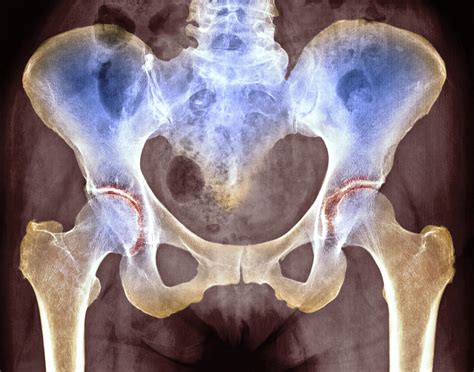 Osteoarthritis Of Hip Joints X Ray Photograph By Pixels