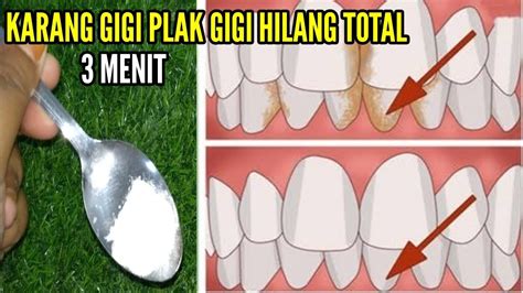 Perubahan warna pada gigi muncul dengan usia, tetapi juga mempengaruhi kebiasaan diet dan gigi whitening gel dihitung dalam cara yang efektif untuk gigi putih. KURANG DARI 3 MENIT ! KARANG DAN PLAK GIGI RONTOK, GIGI ...