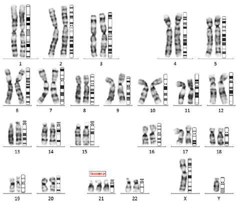 Shows G Banded Karyotype Of Male Down Syndrome With Xy