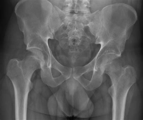 Bilateral Transient Osteoporosis Of The Hip In A 20 Year Old Man Bmj