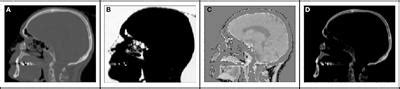 Frontiers Generation Of Synthetic CT Images From MRI For Treatment Planning And Patient