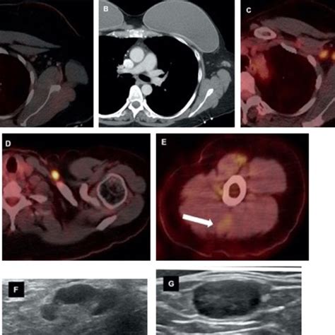 Forty Two Year Old Female With Unilateral Left Axillary Adenopathy