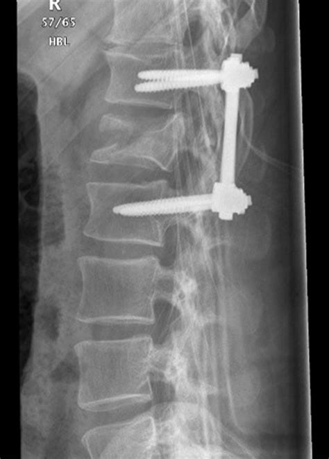 Icd 10 Code For Closed Fracture 4th Vertebrae