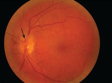 Fundus Photograph Of Glaucomatous Optic Nerve Showing Increased Cupping
