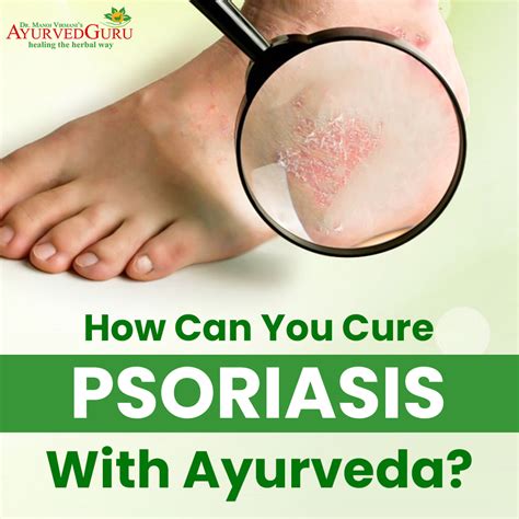 How Can You Cure Psoriasis With Ayurveda Ayurved Guru