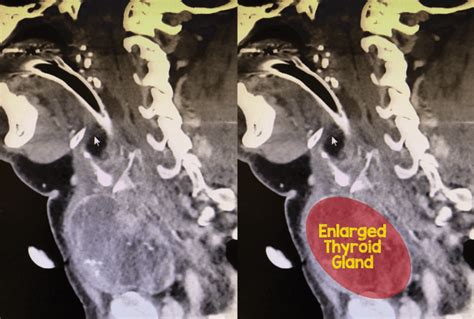 Thyroid Goiter Rebel Em Emergency Medicine Blog