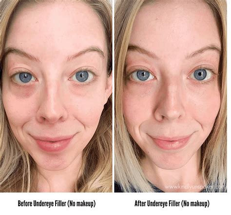Under Eye Fillers For Dark Circles Before And After Kindly Unspoken