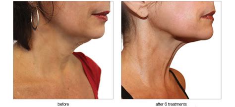 Venus Viva Skin Resurfacing Utah Facial Plastics Slc Utah