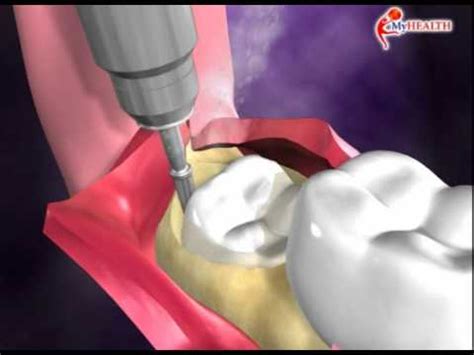 Pasca cabut gigi geraham bawah. MyHEALTH : Gigi Geraham Bongu Terimpak - YouTube