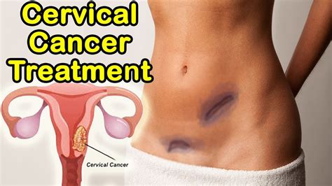 Top 5 Cervical Cancer Treatment Stages Symptoms And More