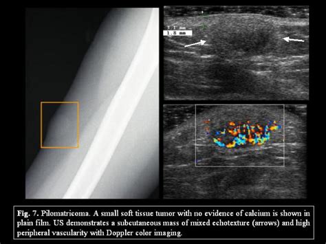 Figure 7 From Benign Lesions Of The Subcutaneous Soft Tissue With