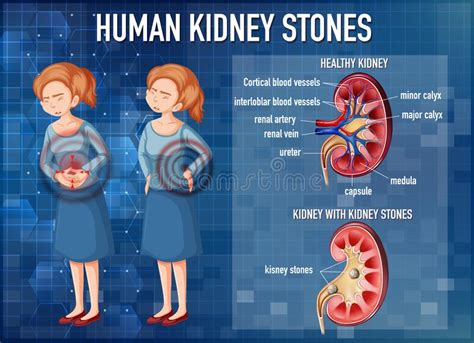 Informative Illustration Of Kidney Stones Stock Vector Illustration