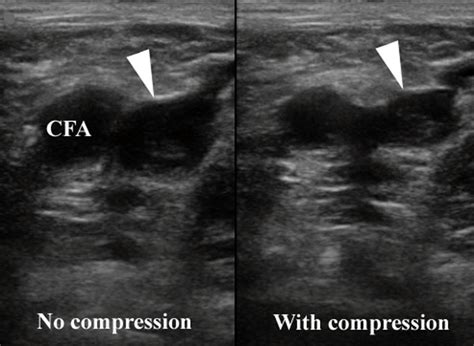 Dvt Images Emergency Ultrasonography