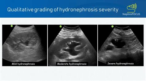 Renal Ultrasound Hydronephrosis And Stones — Brown Emergency Medicine