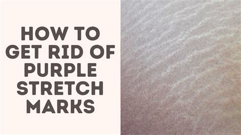 How To Get Rid Of Purple Stretch Marks Treat Your Scars