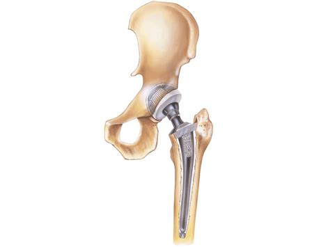 top 14 how long do hip replacements last in 2022 thaiphuongthuy