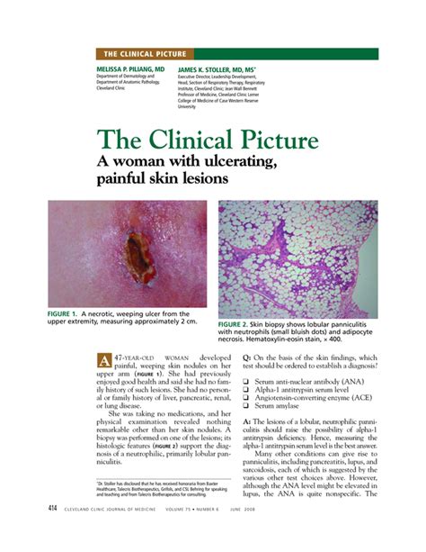 A Woman With Ulcerating Painful Skin Lesions Cleveland Clinic