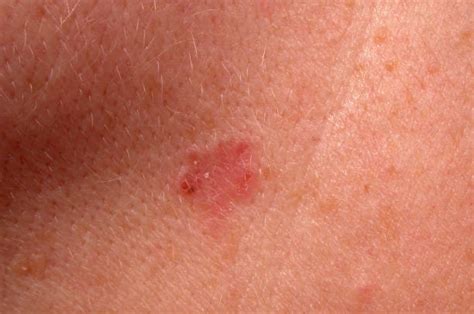 Basal Cell Carcinoma Pictures Getty Images