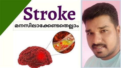 Learn about nipah virus symptoms in plants topic in biology in details explained by subject experts on vedantu.com. Stroke- Causes, Symptoms & Management Explained in ...