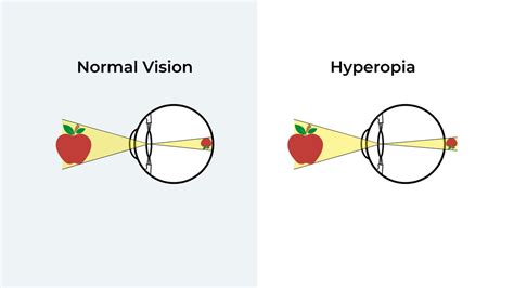 What Is Hyperopia Causes And Treatment Of Long Sightedness