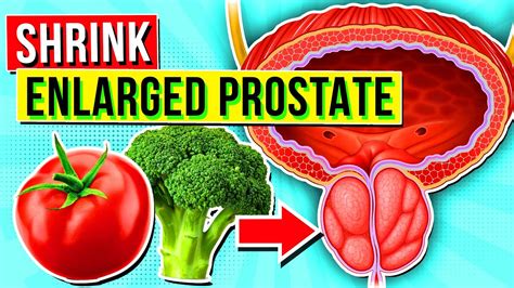 9 Top Foods And Vitamins To Shrink An Enlarged Prostate Youtube