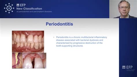 New Classification Of Periodontitis Youtube