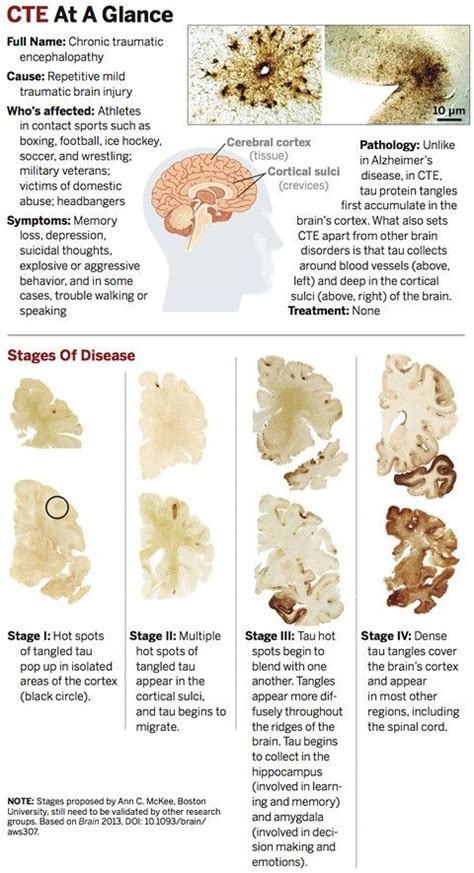 Cte Brain Injury Stages