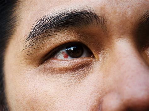Burst Blood Vessel In The Eye Causes And Treatment