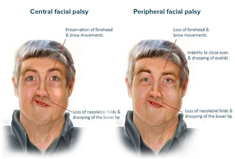 Bell Palsy A Clinical Diagnosis With A Management Challenge