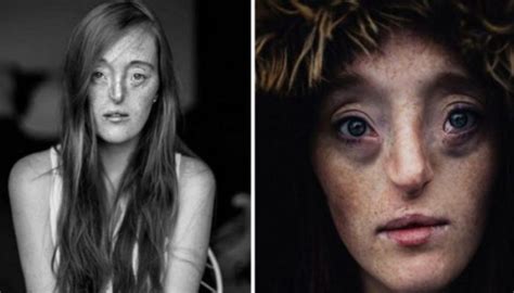 Despite Her Unusual Facial Deformity The Model Proves That True Beauty Comes From Inside