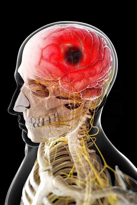 A stroke is a medical condition in which poor blood flow to the brain causes cell death. How a Hemorrhagic Stroke Differs From an Ischemic Stroke