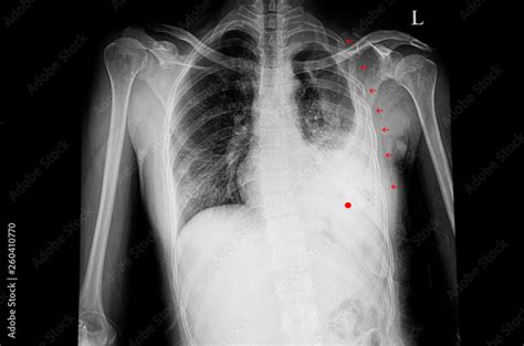Chest Xray Of The Patient With Multiple Rib Fractures And Left