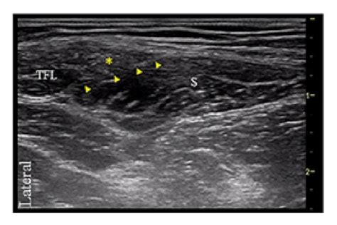 Transverse Ultrasound Image Of The Posterior Femoral Cutaneous Nerve